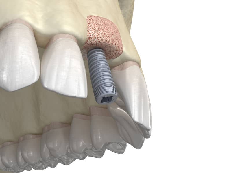 Bone Grafting Teeth Implant