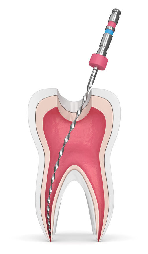 3d render of tooth with endodontic file over white background. Root canal treatment concept.